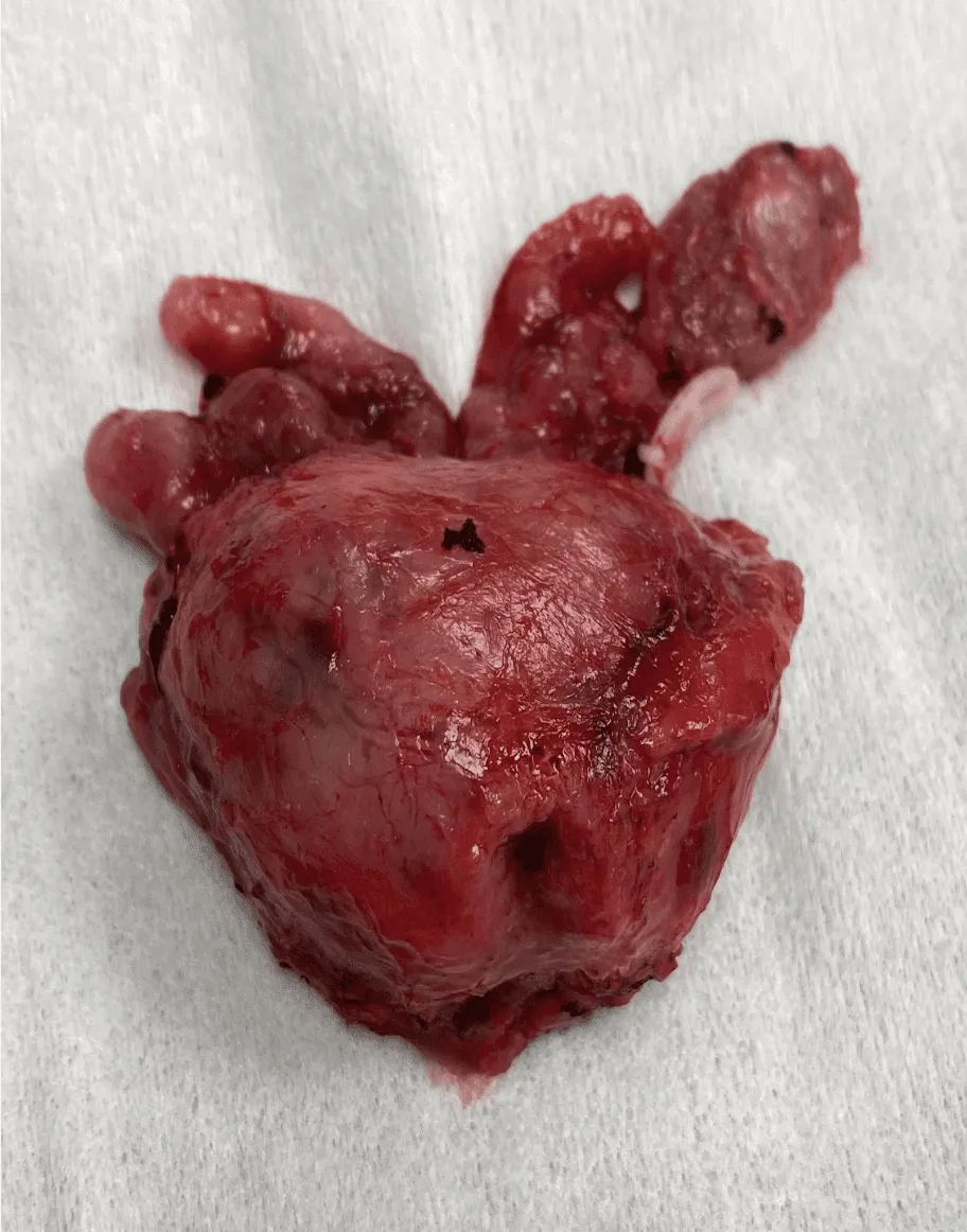Odstránená prostata po operácii